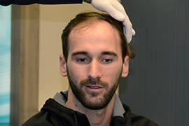 IMPLANT DE CHEVEUX