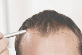 Implant de par cluj