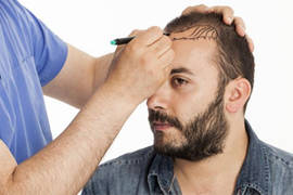 العوامل الطبيعية المؤثرة في زراعة الشعر
