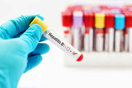 Hepatit B vs. hårtransplantationsprocedur