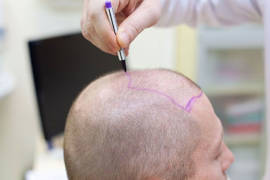 Hair transplant in Turkey vs UK: what are the differences?