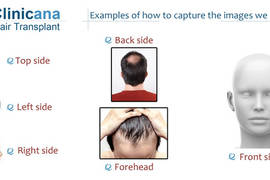 كيف تلتقط الصور اللازمه لأجل معاينه عملية زراعة الشعر