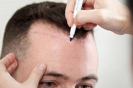 Implant capillaire turquie prix