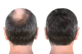 Implant cheveux turquie