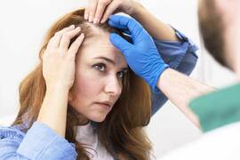 Male pattern baldness in women: what is the treatment?