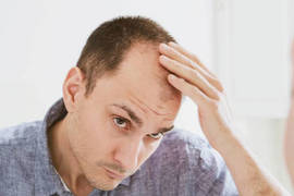 Prosthetic hair or hair transplant: which one is better?