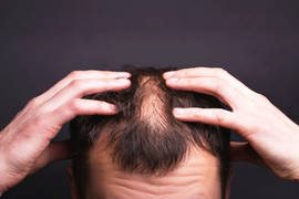 ¿Se puede realizar un trasplante de pelo con psoriasis?