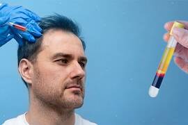 PRP Therapy for Hair Loss in Turkey: Combining Hair Transplant with Platelet-Rich Plasma