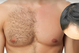 Body hair transplant to head
