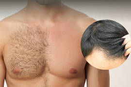 زراعة شعر الرأس باستخدام شعر الجسم