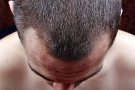 Dandruff and hair loss