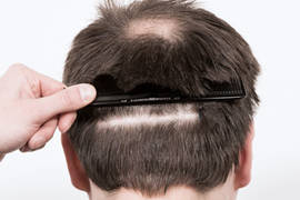 Donor area in a FUE transplant: recovery and healing