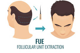 FUE treatment: what are its side effects after a hair transplant?