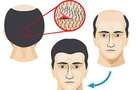 FUT hair transplant: results & recovery time
