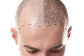 Mesotherapy for hair loss: Does it help hair regrowth?