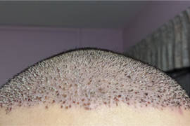 Scabs after your hair transplant