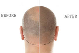 Scalp micropigmentation: an alternative solution for alopecia