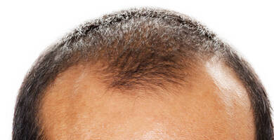 Greffe de cheveux Turquie pas cher