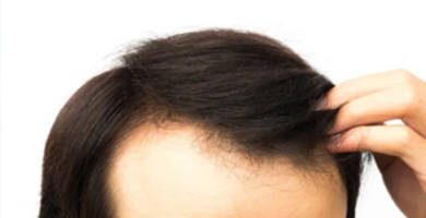 زراعة الشعر الإيطالي البايوفايبر او ما يسمى بالشعر الصناعي