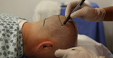 Greffe de cheveux en Turquie