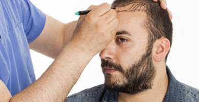 العوامل الطبيعية المؤثرة في زراعة الشعر