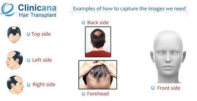 كيف تلتقط الصور اللازمه لأجل معاينه عملية زراعة الشعر
