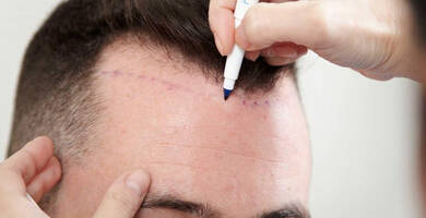 Implant capillaire turquie prix
