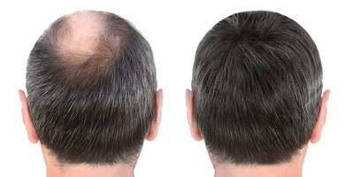 Implant cheveux turquie