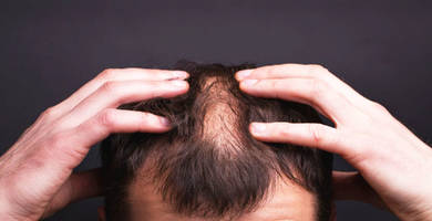 Psoriasis and hair loss: causes, symptoms & treatment