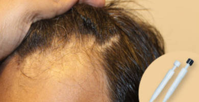 DHI hair transplant in Turkey using the Choi pen