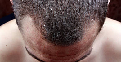 Dandruff and hair loss