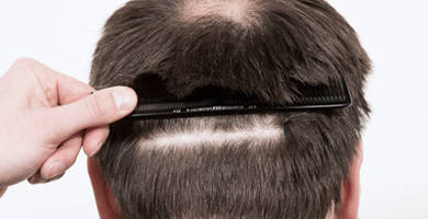 Donor area in a FUE transplant: recovery and healing