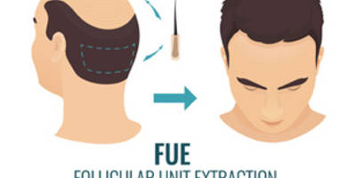 FUE treatment: what are its side effects after a hair transplant?