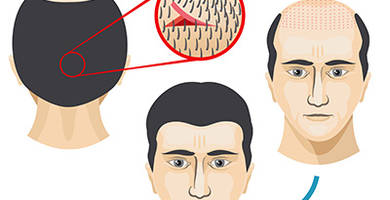 FUT hair transplant: results & recovery time