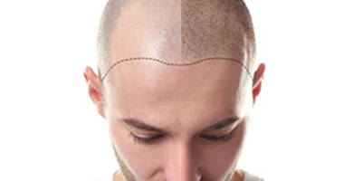 مراحل عملية زراعة الشعر