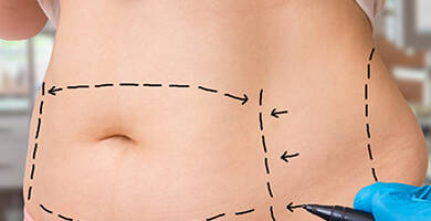 Liposuction Techniques and Advantages
