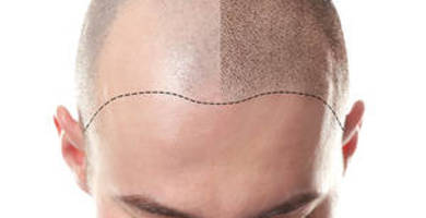 Mesotherapy for hair loss: Does it help hair regrowth?