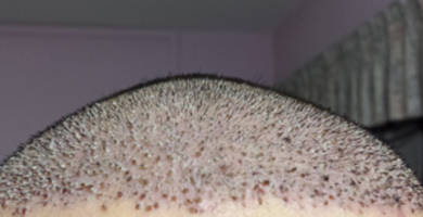 Scabs after your hair transplant