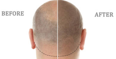 Scalp micropigmentation: an alternative solution for alopecia