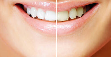 Teeth whitening