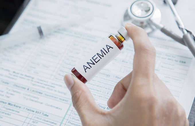 Anämie und Haarausfall: Ursachen und Lösungen