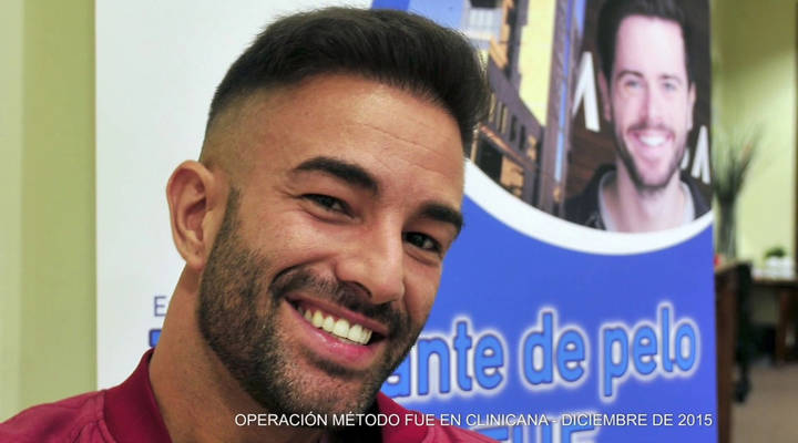 implante capilar de Sandro de Quién quiere casarse con mi hijo