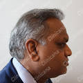 Result after hair transplant