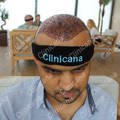 After hair transplant
