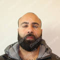 Before hair transplant
