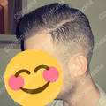 Result after hair transplant