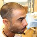 قبل زراعة الشعر في تركيا