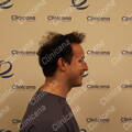 First hair transplant Result