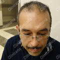 Avant la greffe de cheveux