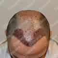 Na haartransplantatie